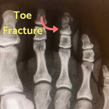 Photo of Broken toe/foot type boot/shoe (Right Foot) - Lordswood (Lords Wood ME5) #1